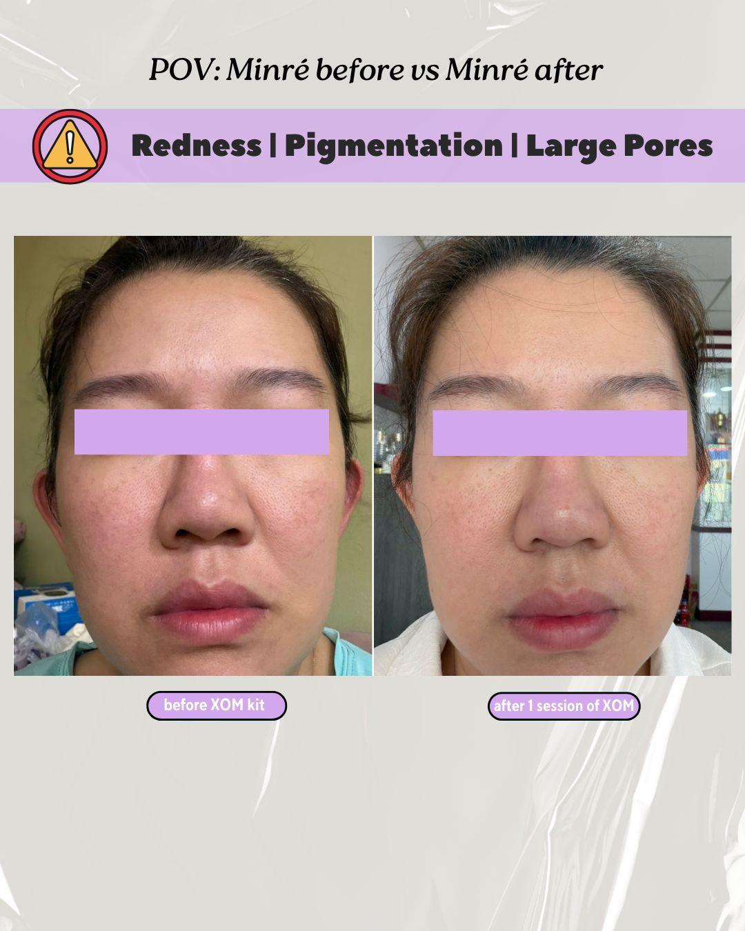 pigmentation and pores