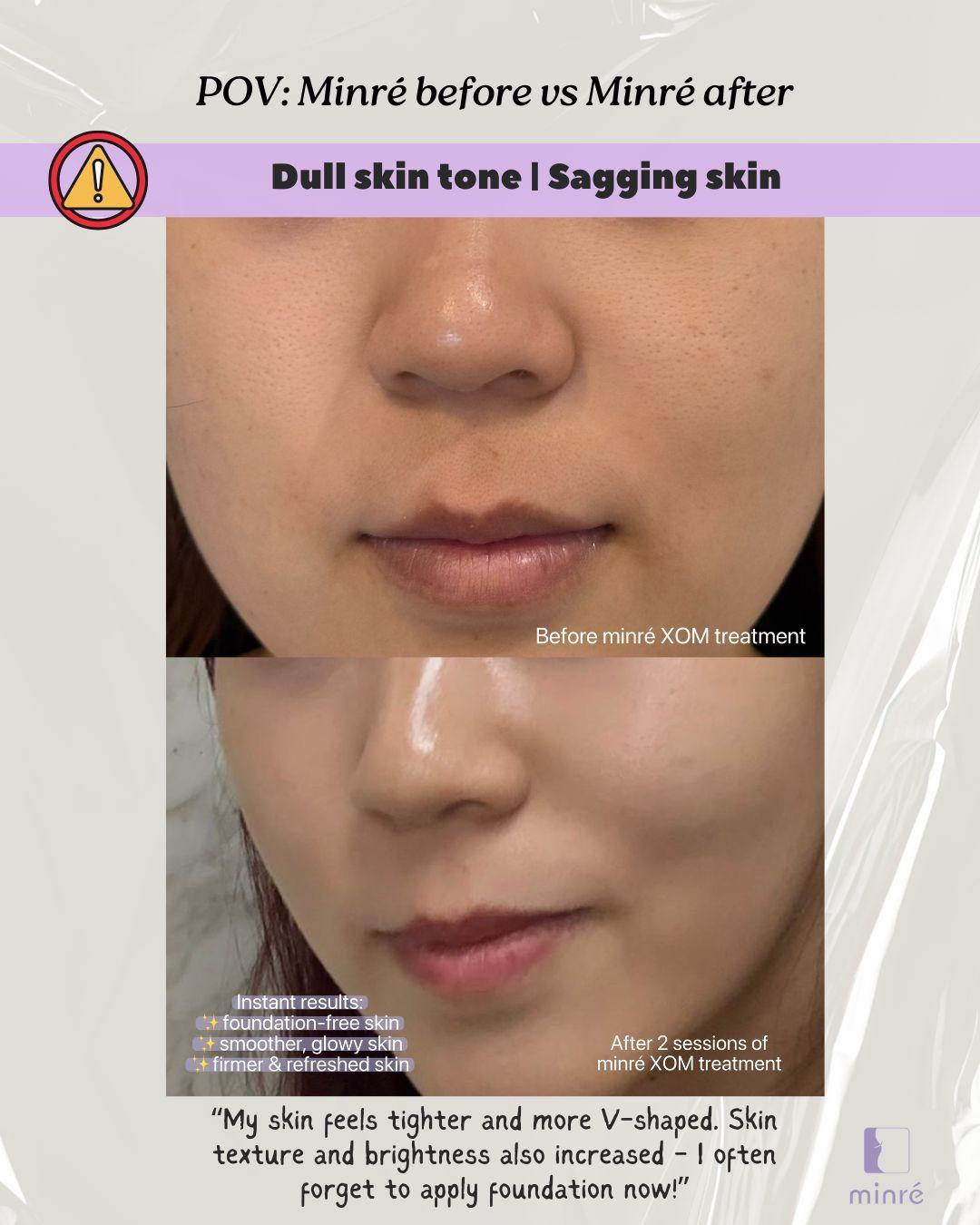 dull skin, lifting
