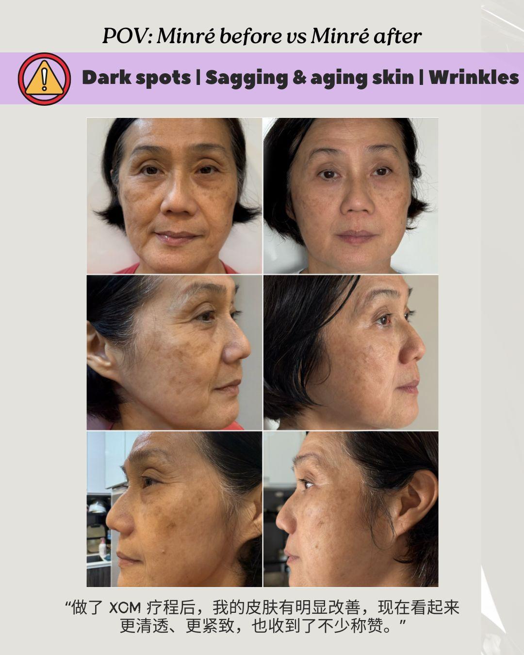 pigment and wrinkles