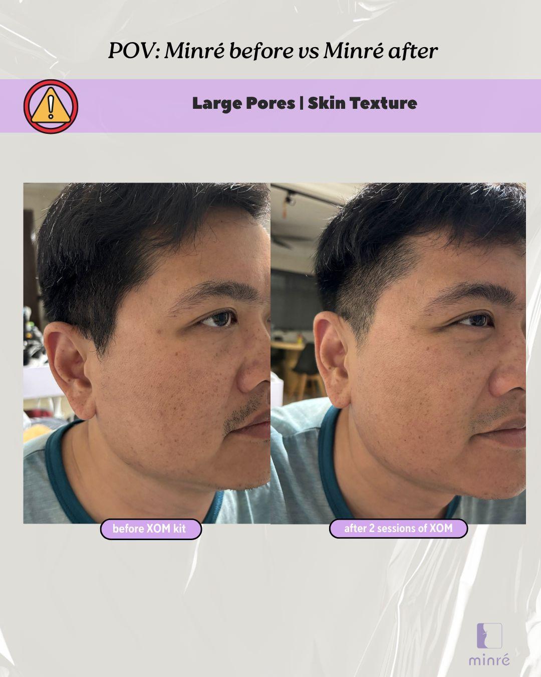 large pores, skintone