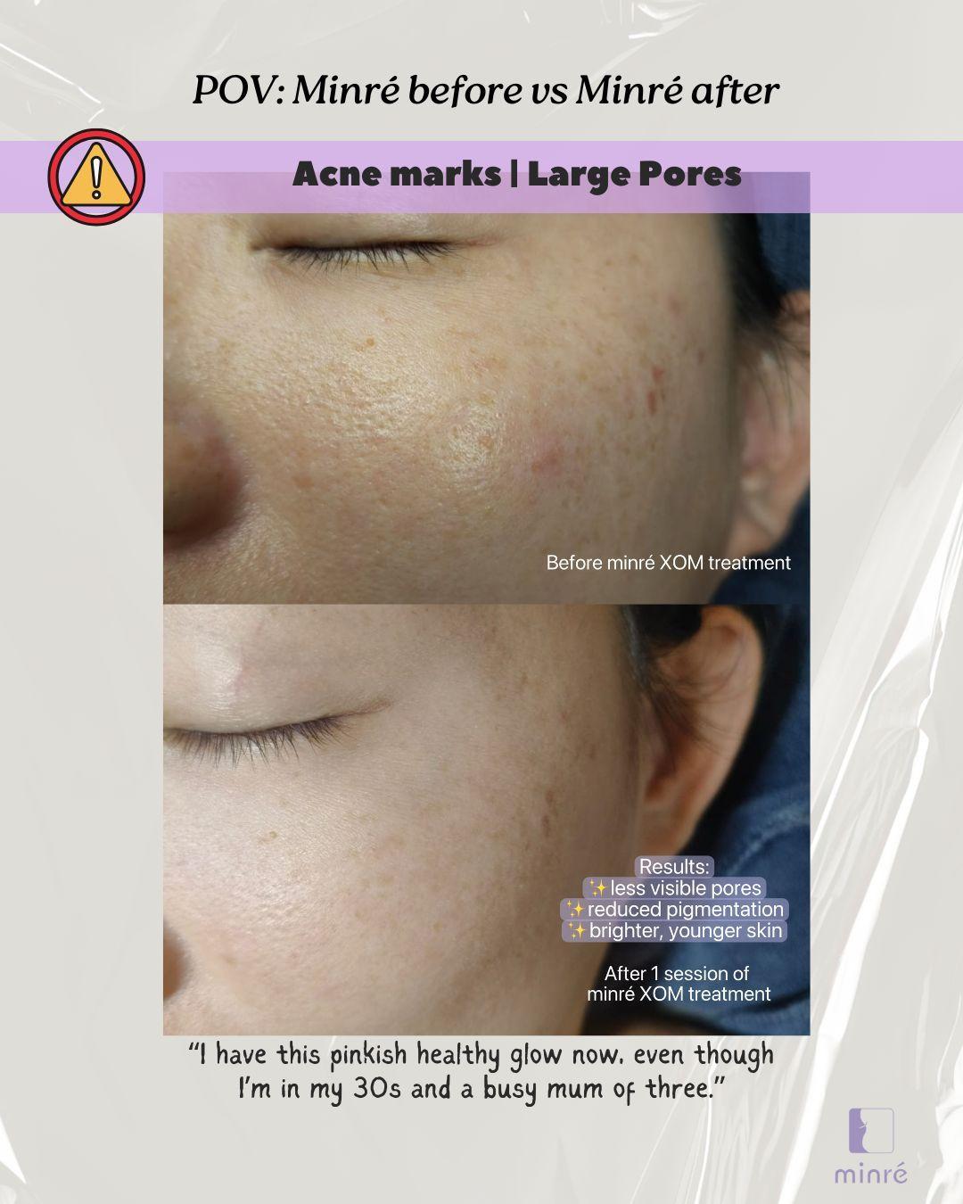pores, pigment