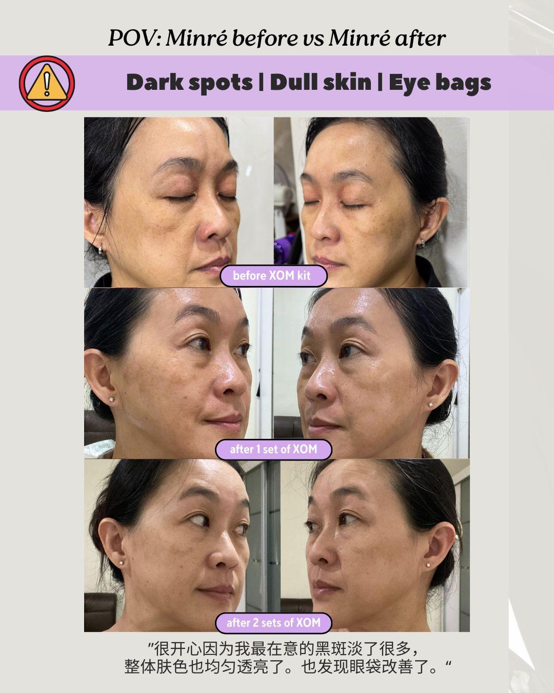 dark spots, eyebag