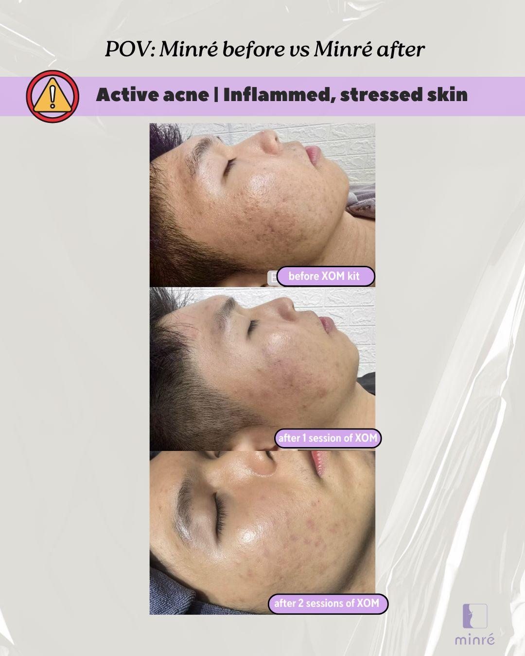 acne scar and acne