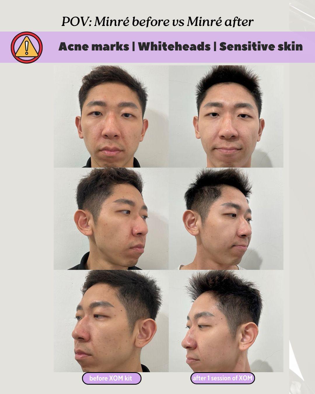 whiteheads, sensitive skin