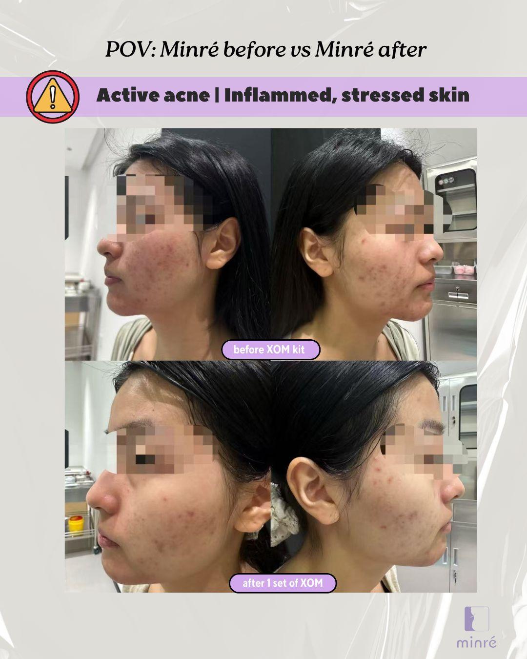 active acne sensitive skin