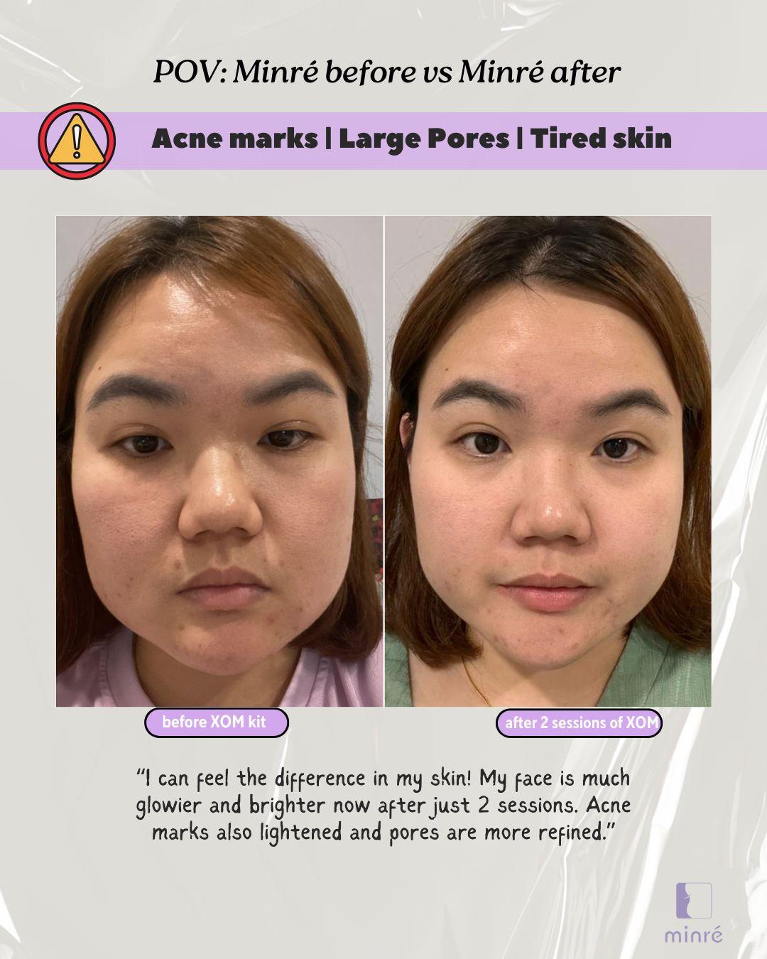acne marks, tired skin