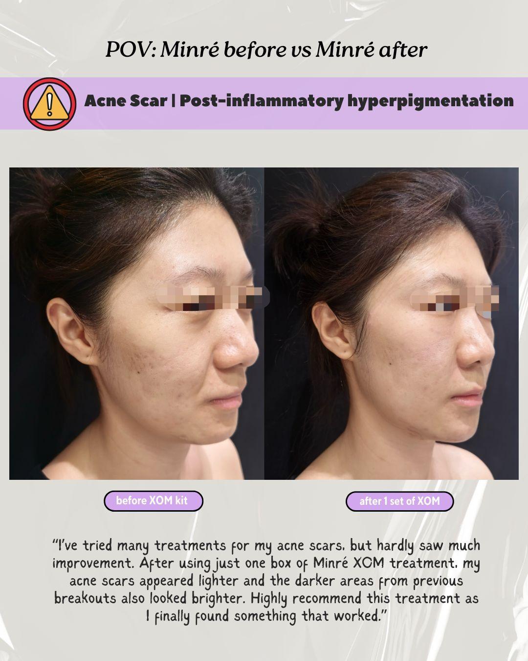 acne scars, post inflammatory hyperpigmentation