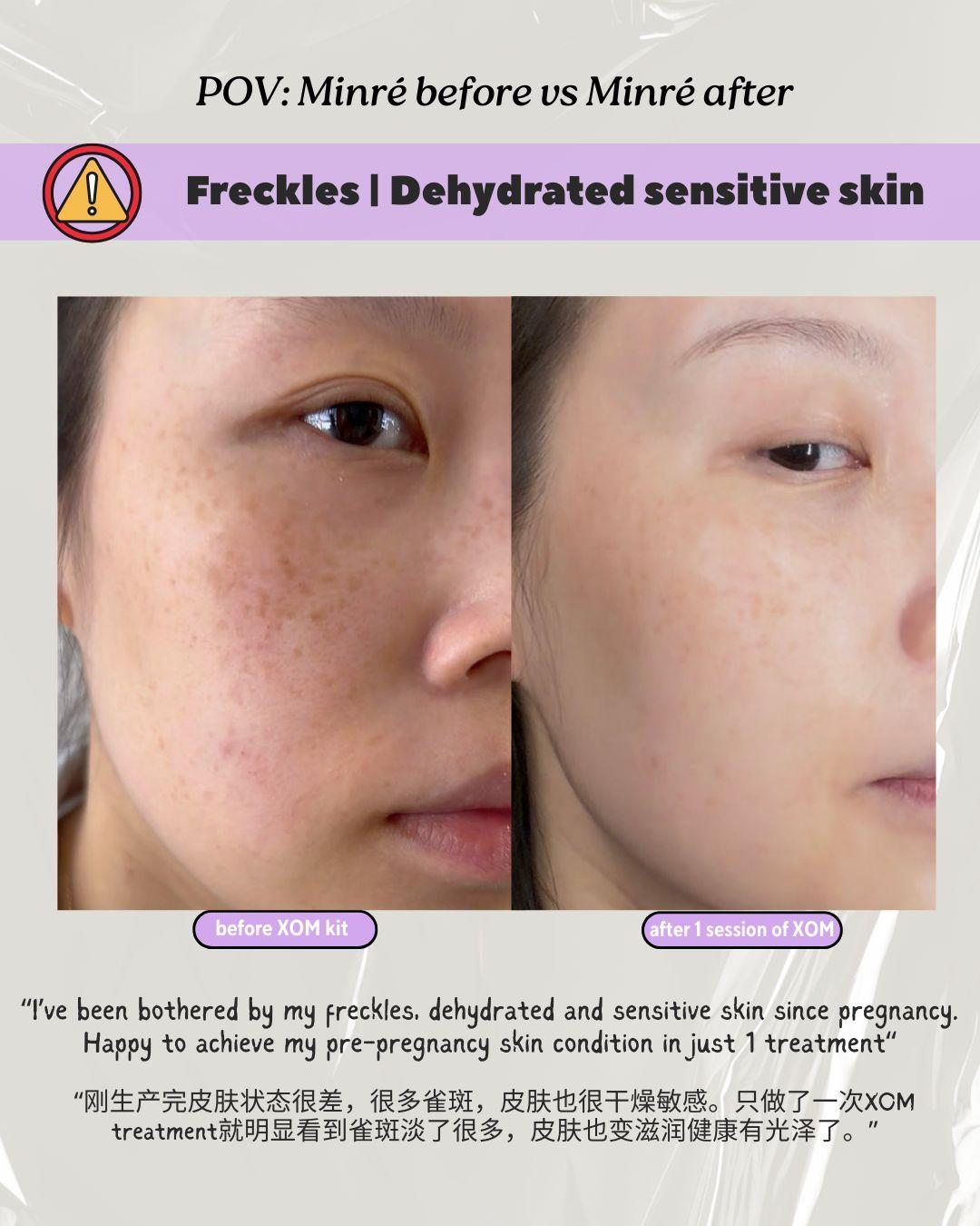freckles, dehydrated post pregnancy skin
