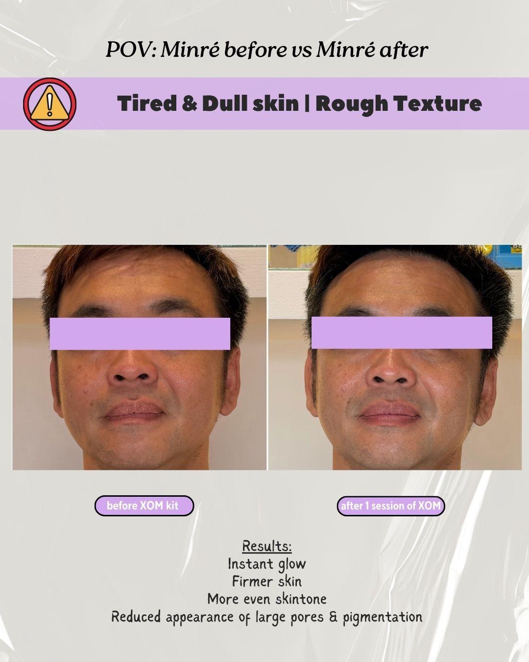 dull rough skin